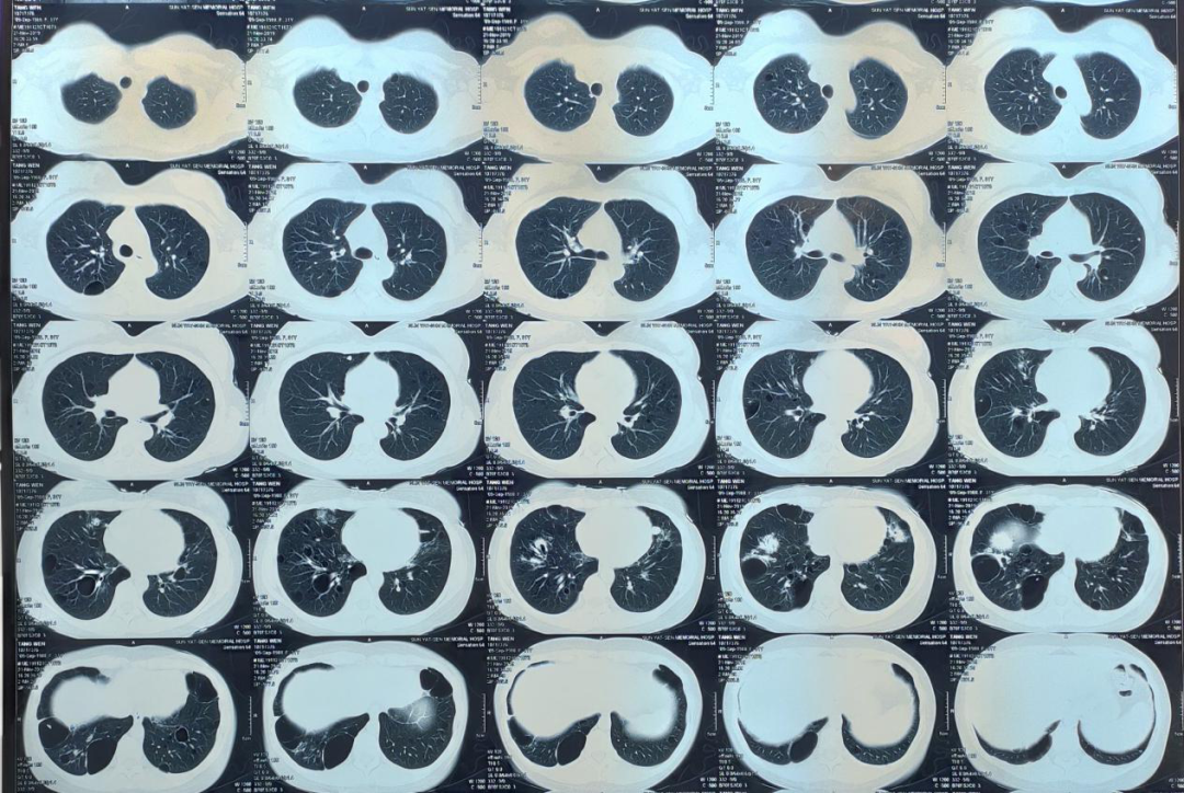 图2  2019年胸部ct.png